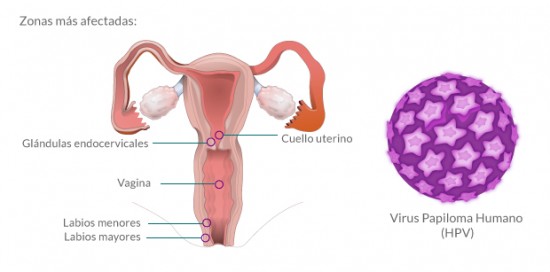HPV-infografia1