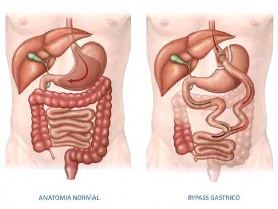 bypass-gastrico