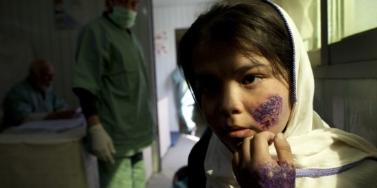 KABUL, AFGHANISTAN - OCTOBER 26  Shafiqa,14, waits for treatment at a free specialized clinic for leishmaniasis supported by World Health Organization (WHO) October 26, 2010 in Kabul, Afghanistan. Leishmaniasis is a disease caused by a parasite transmitted by a tiny sandfly that can lead to severe scarring, often on the face. Leishmaniasis plagues Afghanistan's poor, who often sleep on the floor, and the disease isn't a priority for the government and its aid donors who are grappling with infant mortality, tuberculosis, malaria and trauma. The most common form of the disease is not fatal, but causes untold misery and scarring on faces, stigmatizing children who are excluded at school and making it hard for girls to find husbands. According to WHO,  there were an estimated 65,000 reported cases from the 2009. (Photo by Paula Bronstein/Getty Images)