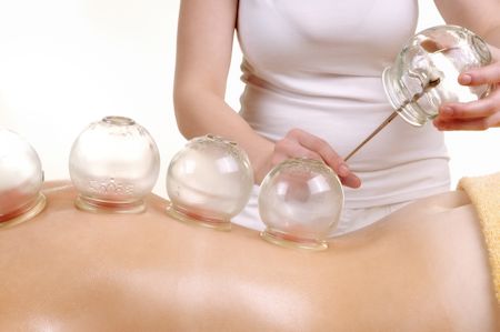 Cupping-Treatment